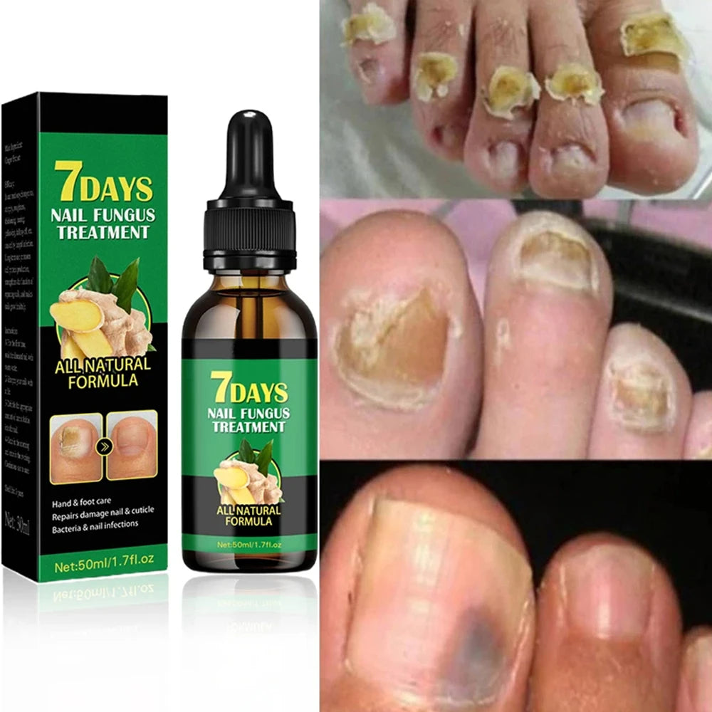 Fungal Nail Treatment Essence Oil Nail Fungus Laser Device Repair Toenail Fingernail Ginger Treatment Hand Foot Essence Liquid