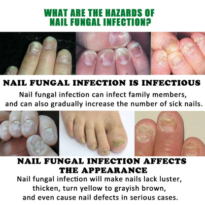 Fungal Nail Treatment Essence Oil Nail Fungus Laser Device Repair Toenail Fingernail Ginger Treatment Hand Foot Essence Liquid