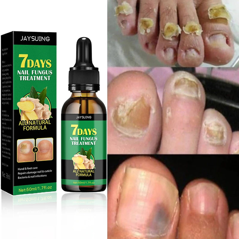 Fungal Nail Treatment Essence Oil Nail Fungus Laser Device Repair Toenail Fingernail Ginger Treatment Hand Foot Essence Liquid