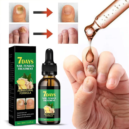 Fungal Nail Treatment Essence Oil Nail Fungus Laser Device Repair Toenail Fingernail Ginger Treatment Hand Foot Essence Liquid