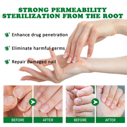 Fungal Nail Treatment Essence Oil Nail Fungus Laser Device Repair Toenail Fingernail Ginger Treatment Hand Foot Essence Liquid