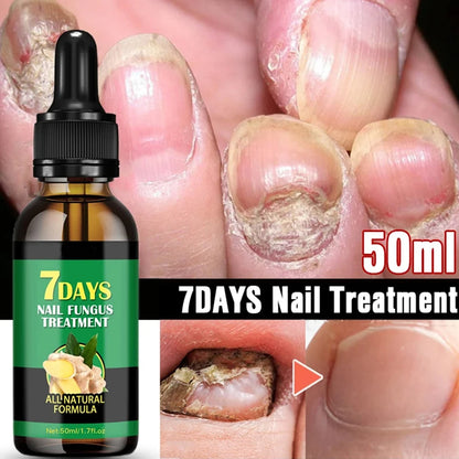 Fungal Nail Treatment Essence Oil Nail Fungus Laser Device Repair Toenail Fingernail Ginger Treatment Hand Foot Essence Liquid